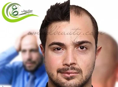 درمان ریزش مو هورمونی