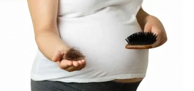 درمان ریزش مو در بارداری 
